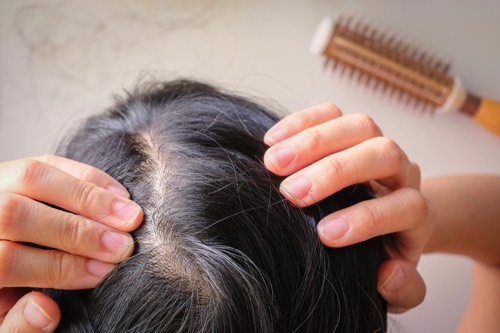 Tratamientos capilares para la pérdida de cabello » Tratamiento con PRP para la caída moderada del cabello - mini