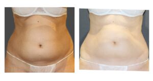 Antes y después Coolsculpting